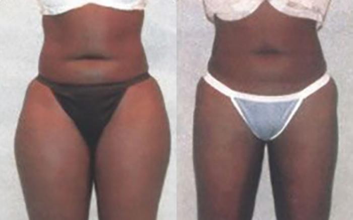 Before & After Liposuction Case 3837 View 1 View in Houston, TX