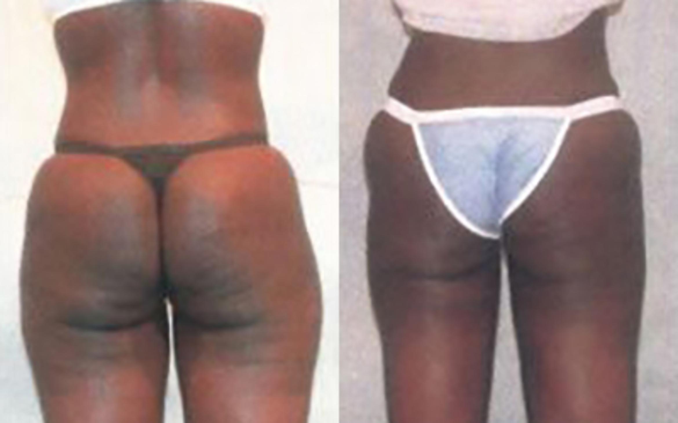Before & After Liposuction Case 3837 View 2 View in Houston, TX