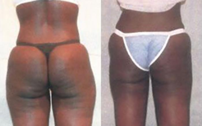 Before & After Liposuction Case 3837 View 2 View in Houston, TX
