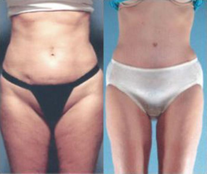 Before & After Liposuction Case 3843 View 1 View in Houston, TX