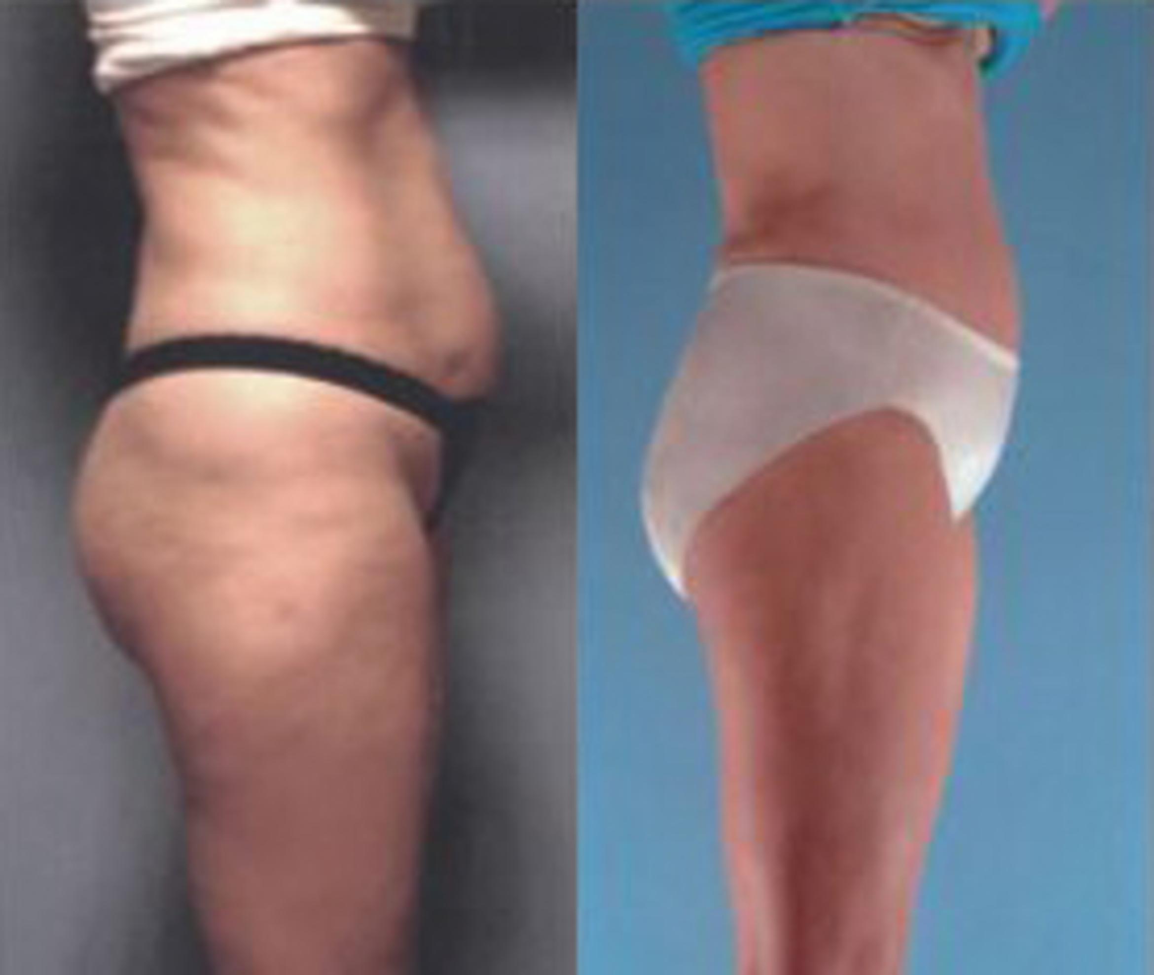 Before & After Liposuction Case 3843 View 2 View in Houston, TX