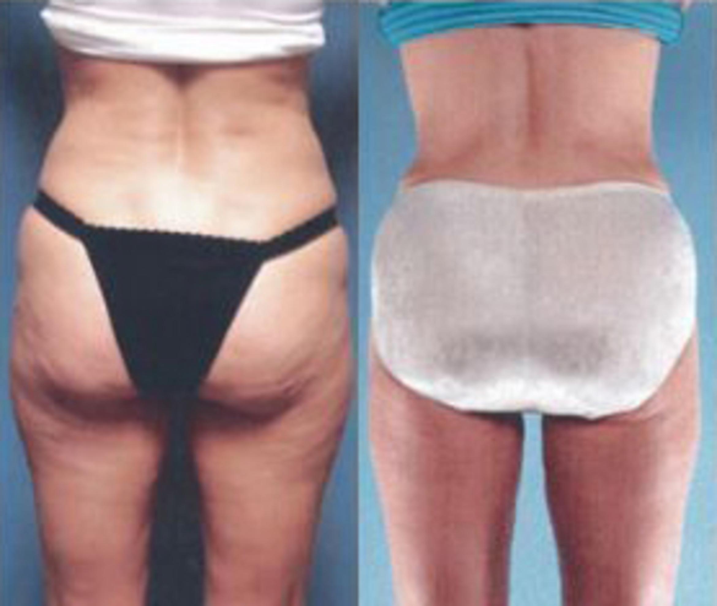 Before & After Liposuction Case 3843 View 3 View in Houston, TX