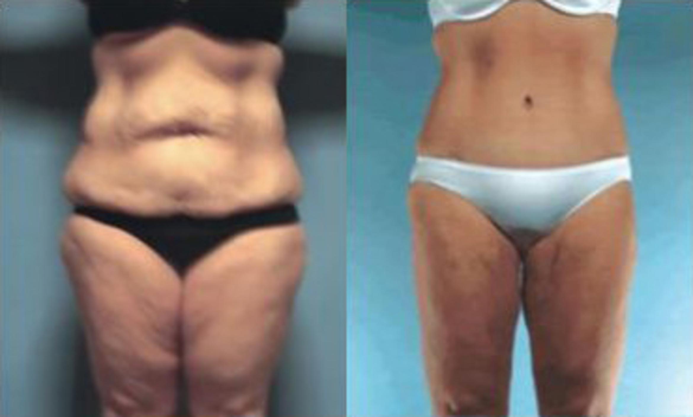 Before & After Liposuction Case 3851 View 1 View in Houston, TX