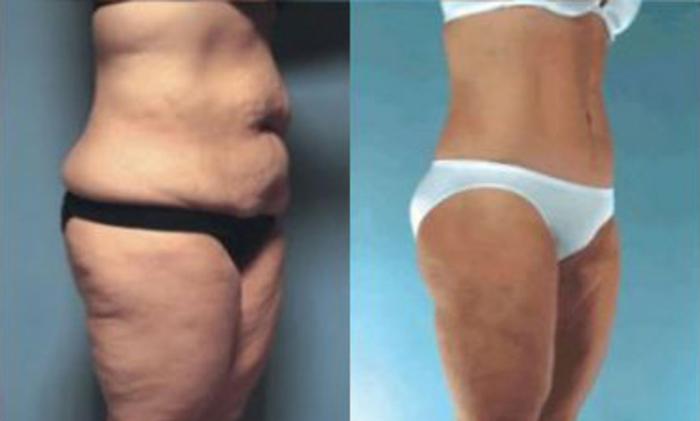 Before & After Liposuction Case 3851 View 2 View in Houston, TX
