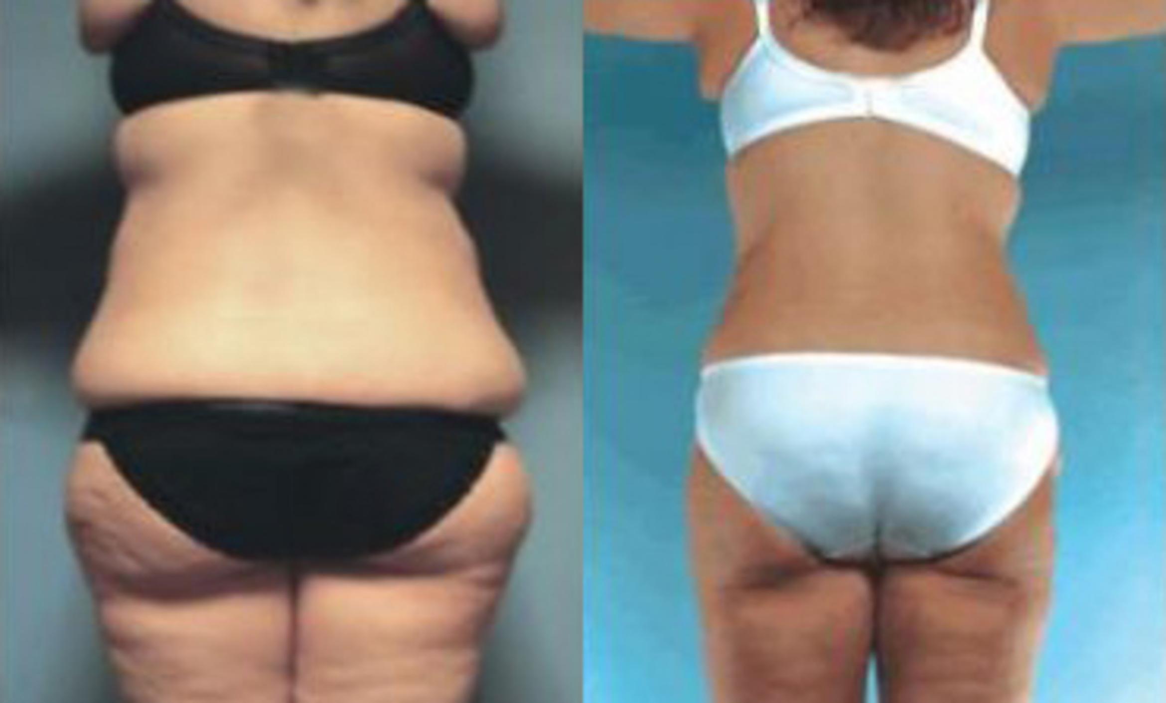 Before & After Liposuction Case 3851 View 3 View in Houston, TX