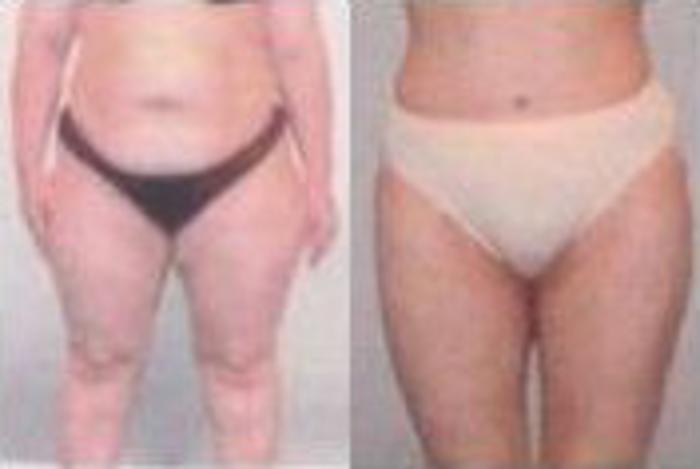 Before & After Liposuction Case 3859 View 1 View in Houston, TX