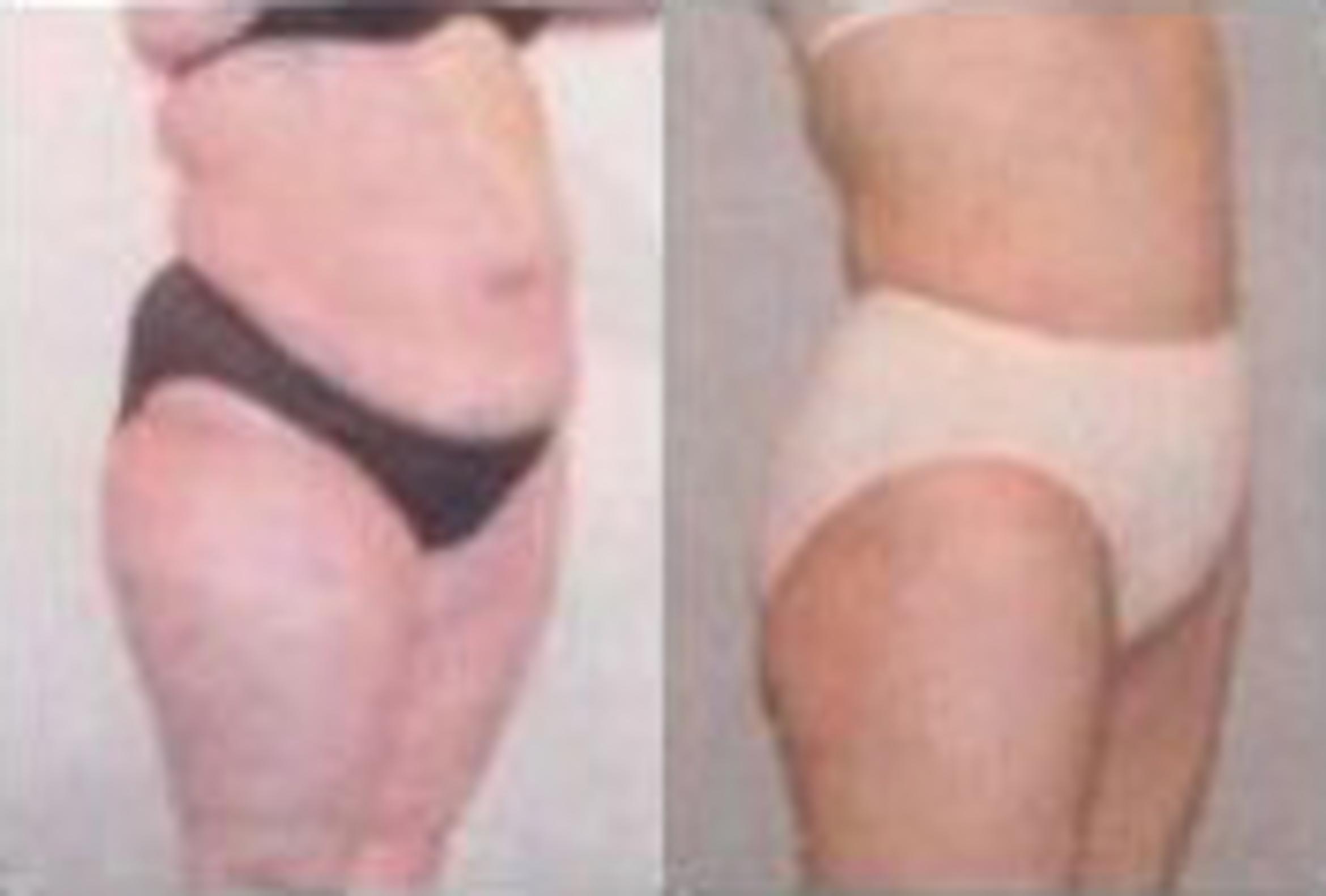 Before & After Liposuction Case 3859 View 2 View in Houston, TX