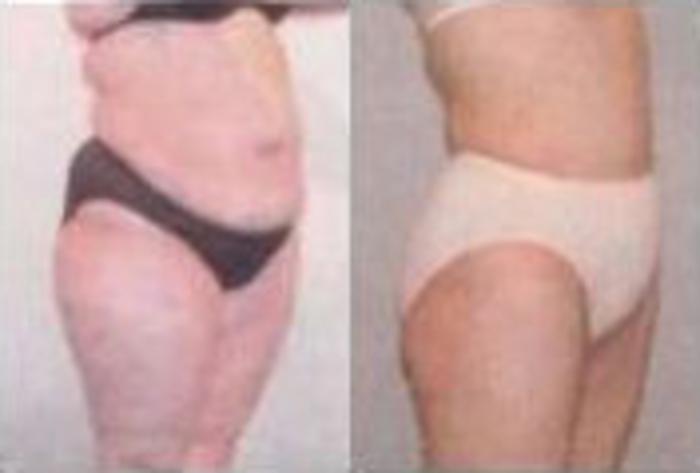 Before & After Liposuction Case 3859 View 2 View in Houston, TX