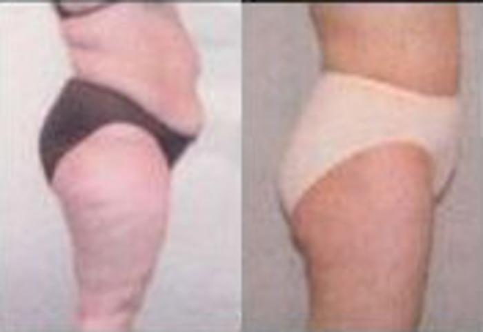 Before & After Liposuction Case 3859 View 3 View in Houston, TX