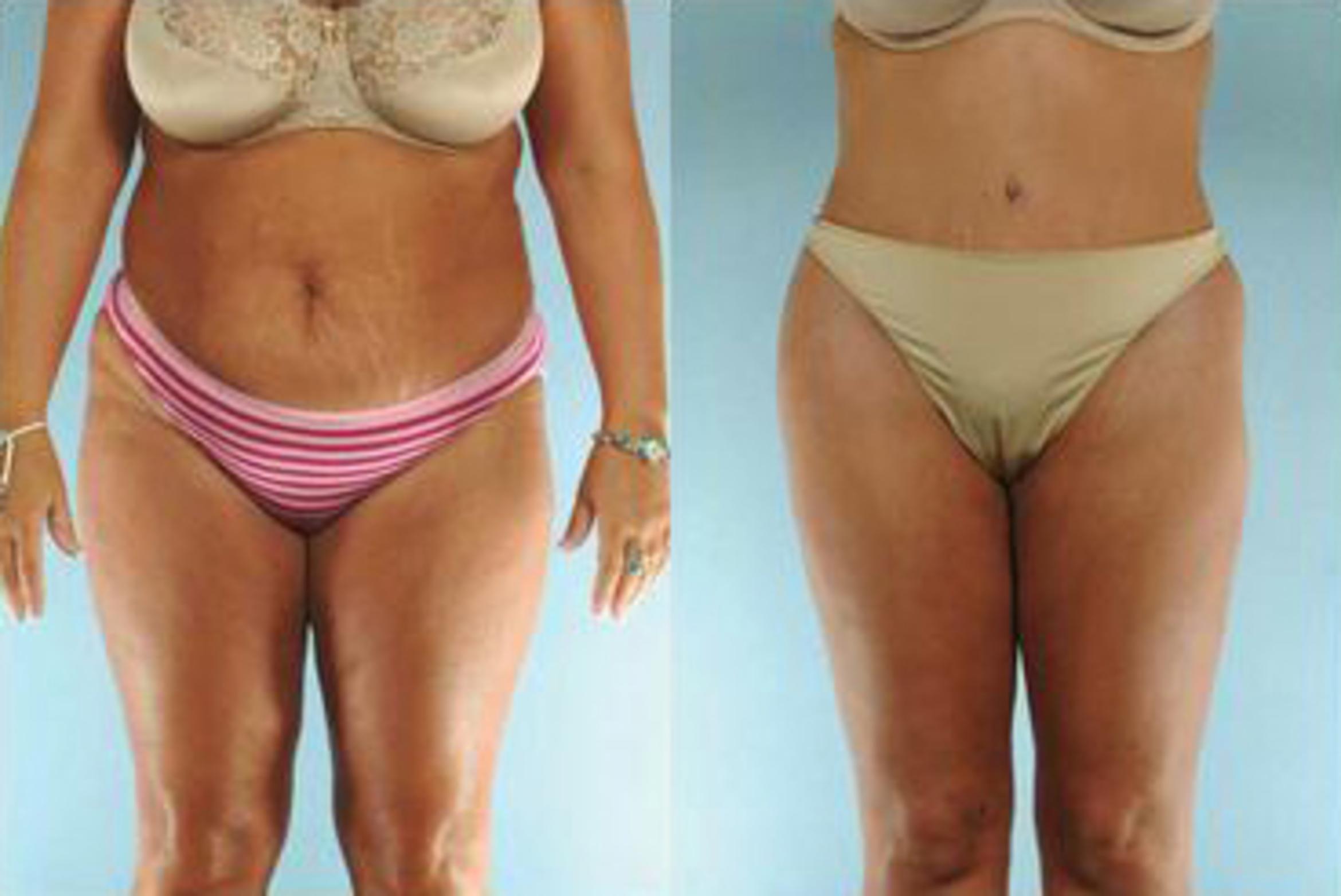 Before & After Liposuction Case 3867 View 1 View in Houston, TX
