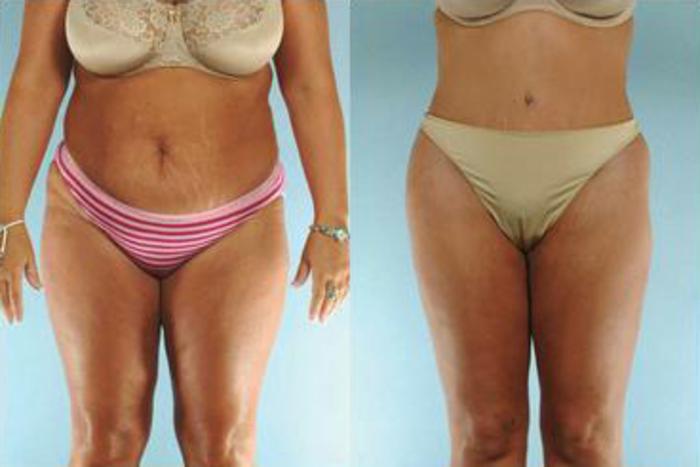 Before & After Liposuction Case 3867 View 1 View in Houston, TX