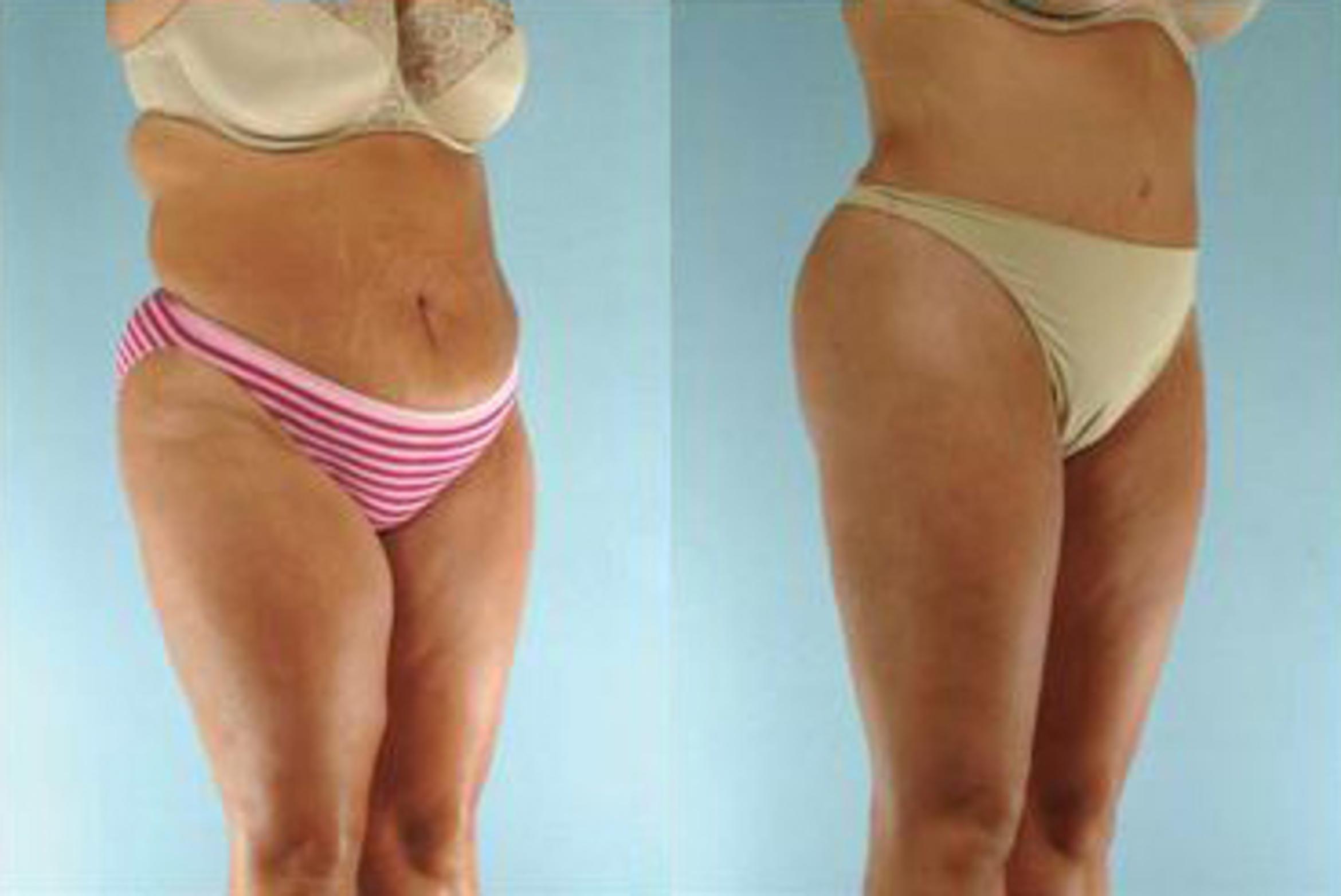 Before & After Liposuction Case 3867 View 2 View in Houston, TX