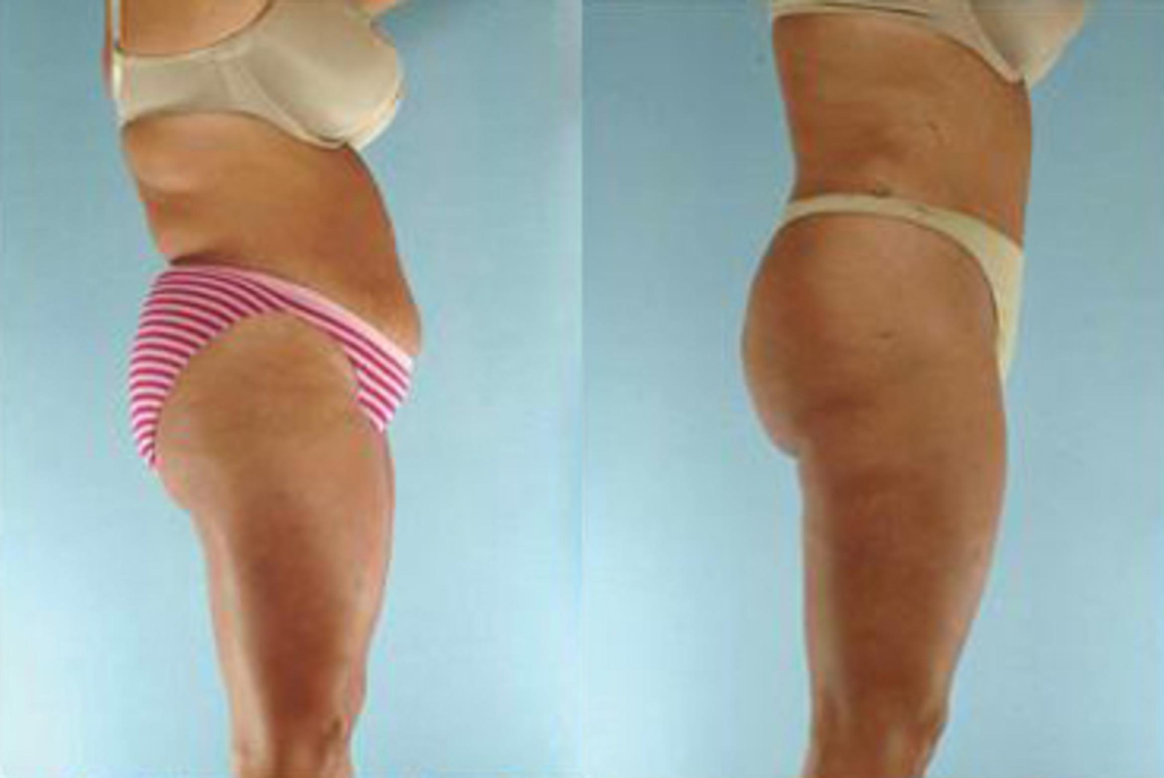 Before & After Liposuction Case 3867 View 3 View in Houston, TX