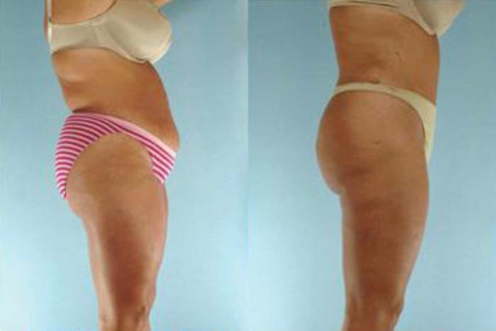 Before & After Liposuction Case 3867 View 3 View in Houston, TX