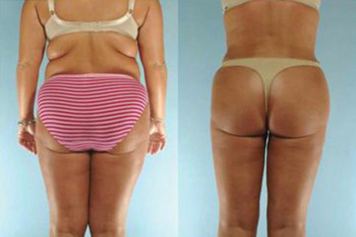 Before & After Liposuction Case 3867 View 4 View in Houston, TX