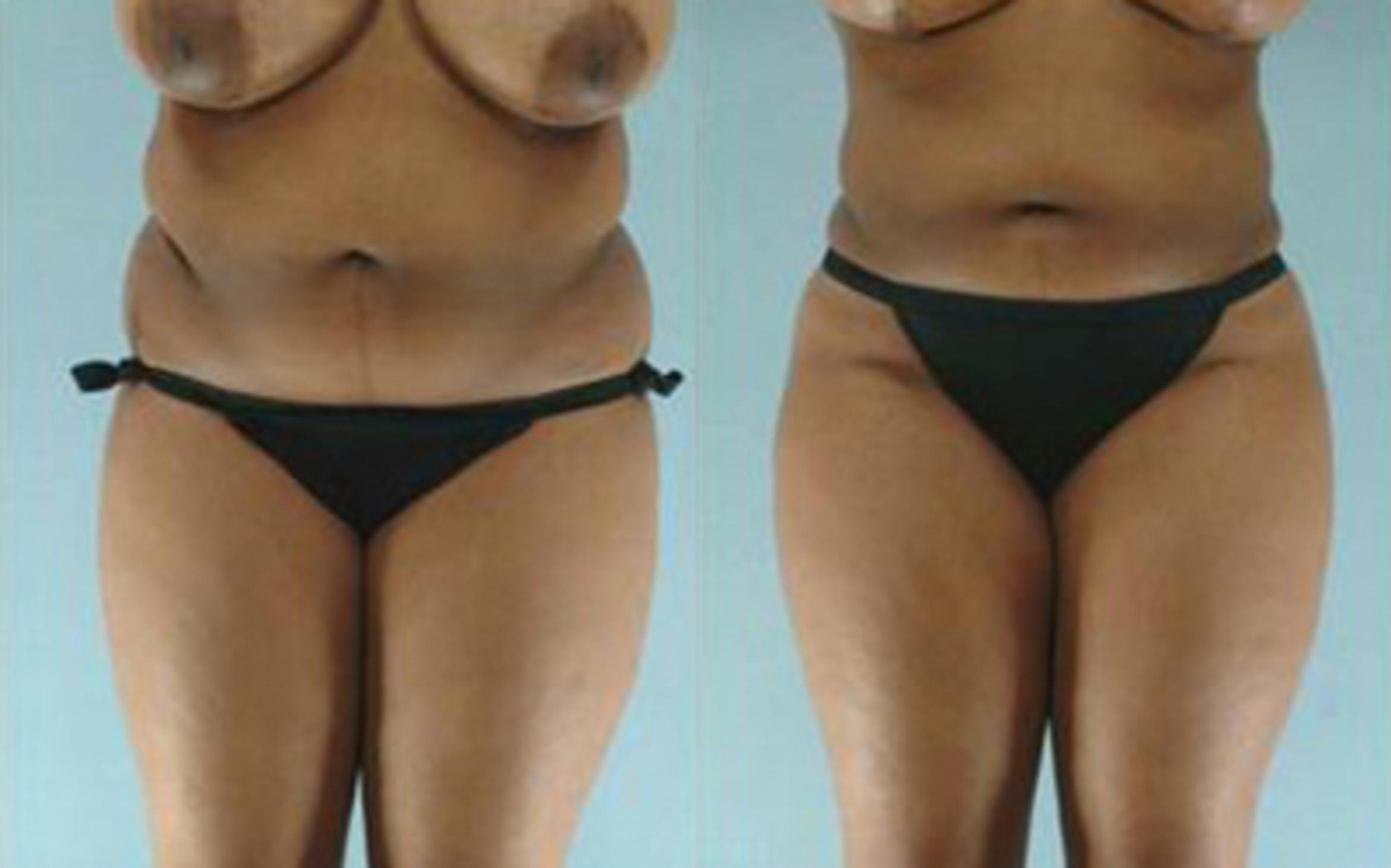 Before & After Liposuction Case 3877 View 1 View in Houston, TX