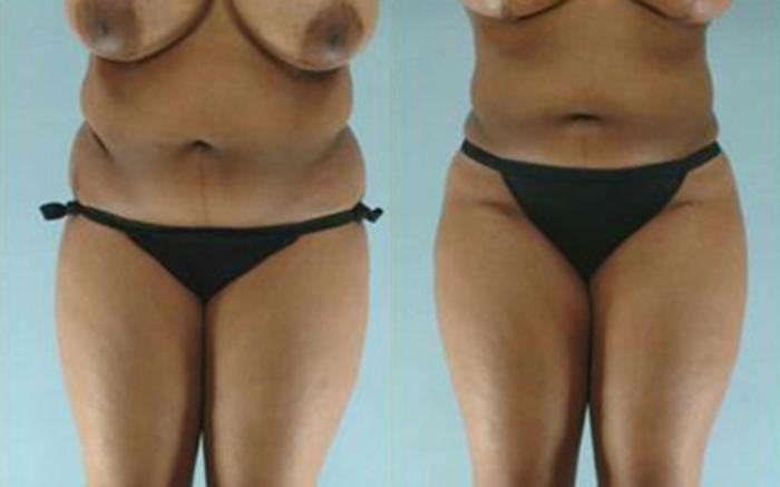 Before & After Liposuction Case 3877 View 1 View in Houston, TX