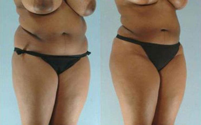 Before & After Liposuction Case 3877 View 2 View in Houston, TX