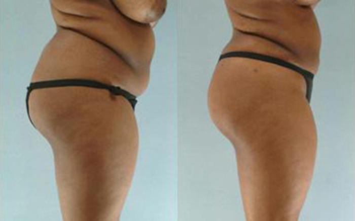 Before & After Liposuction Case 3877 View 3 View in Houston, TX