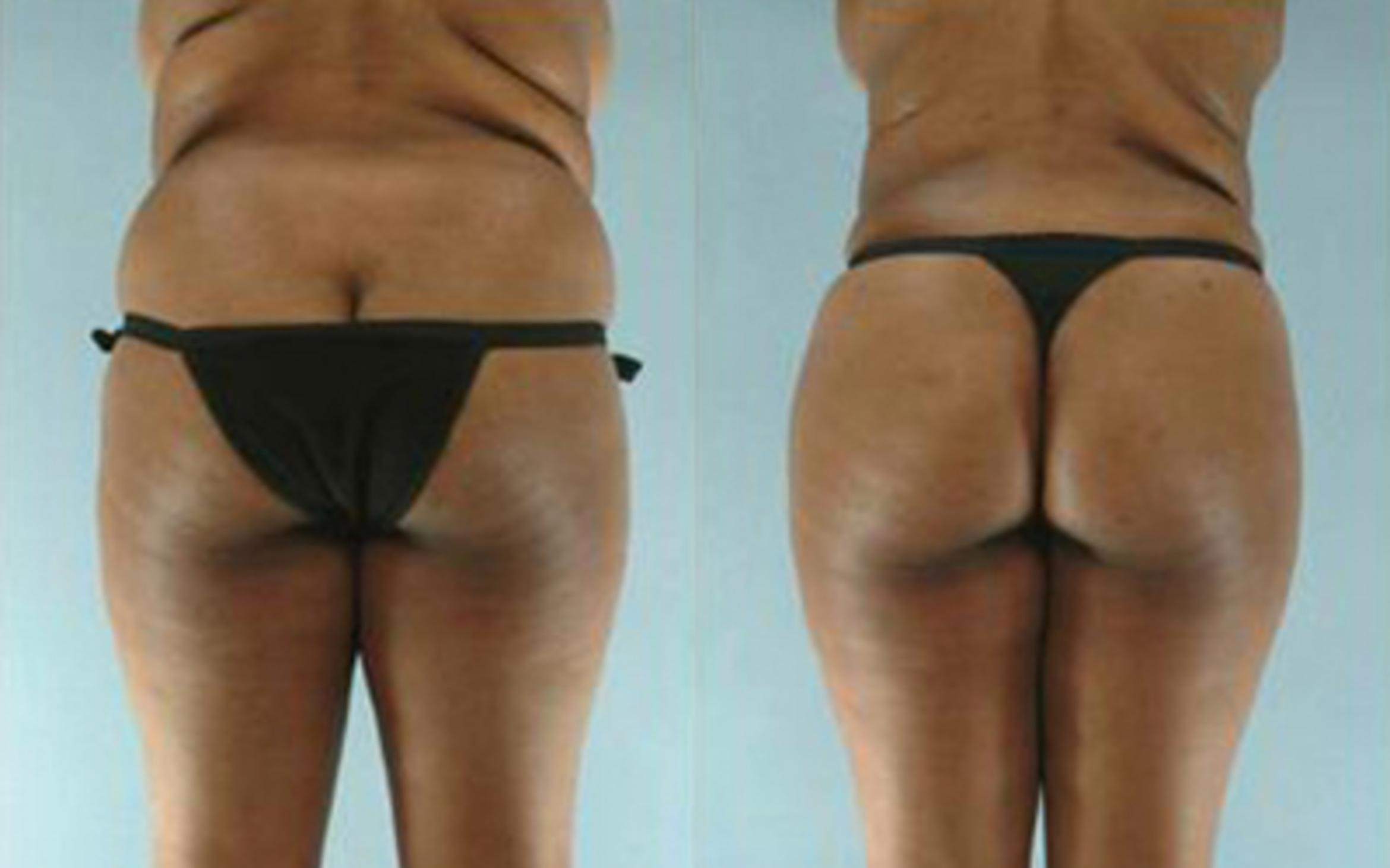 Before & After Liposuction Case 3877 View 4 View in Houston, TX