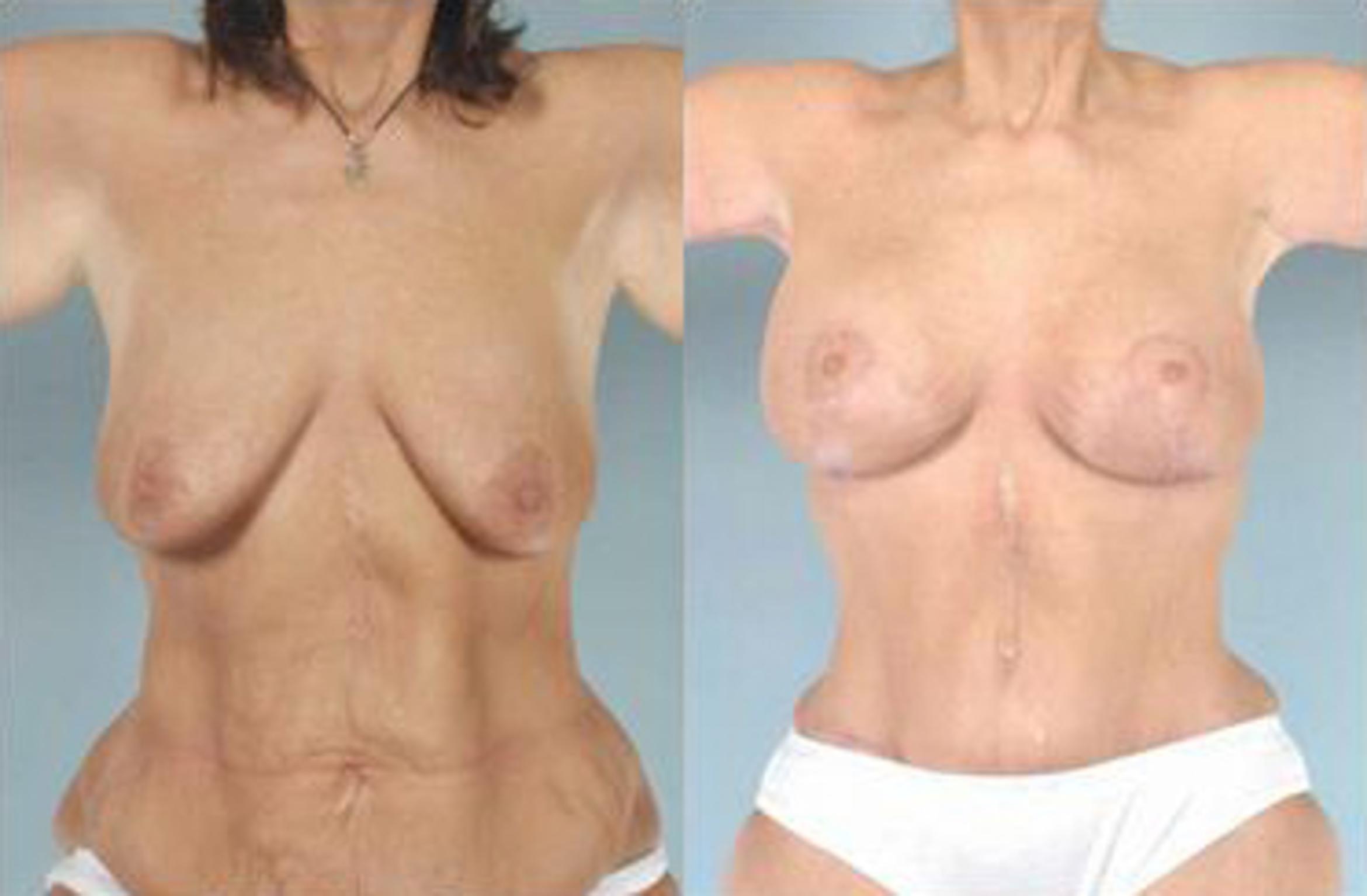 Before & After Liposuction Case 3887 View 1 View in Houston, TX