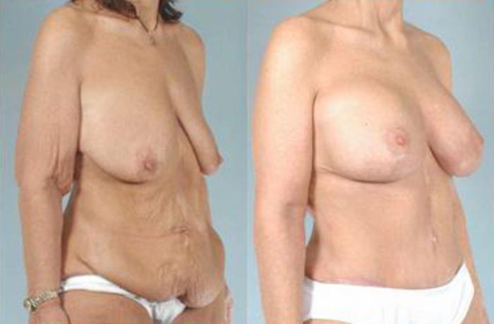 Before & After Liposuction Case 3887 View 2 View in Houston, TX