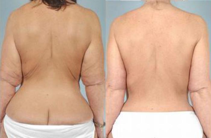 Before & After Liposuction Case 3887 View 4 View in Houston, TX