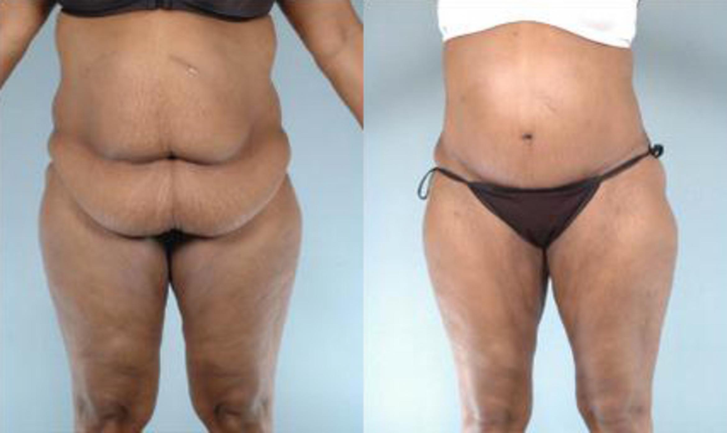 Before & After Liposuction Case 3897 View 1 View in Houston, TX