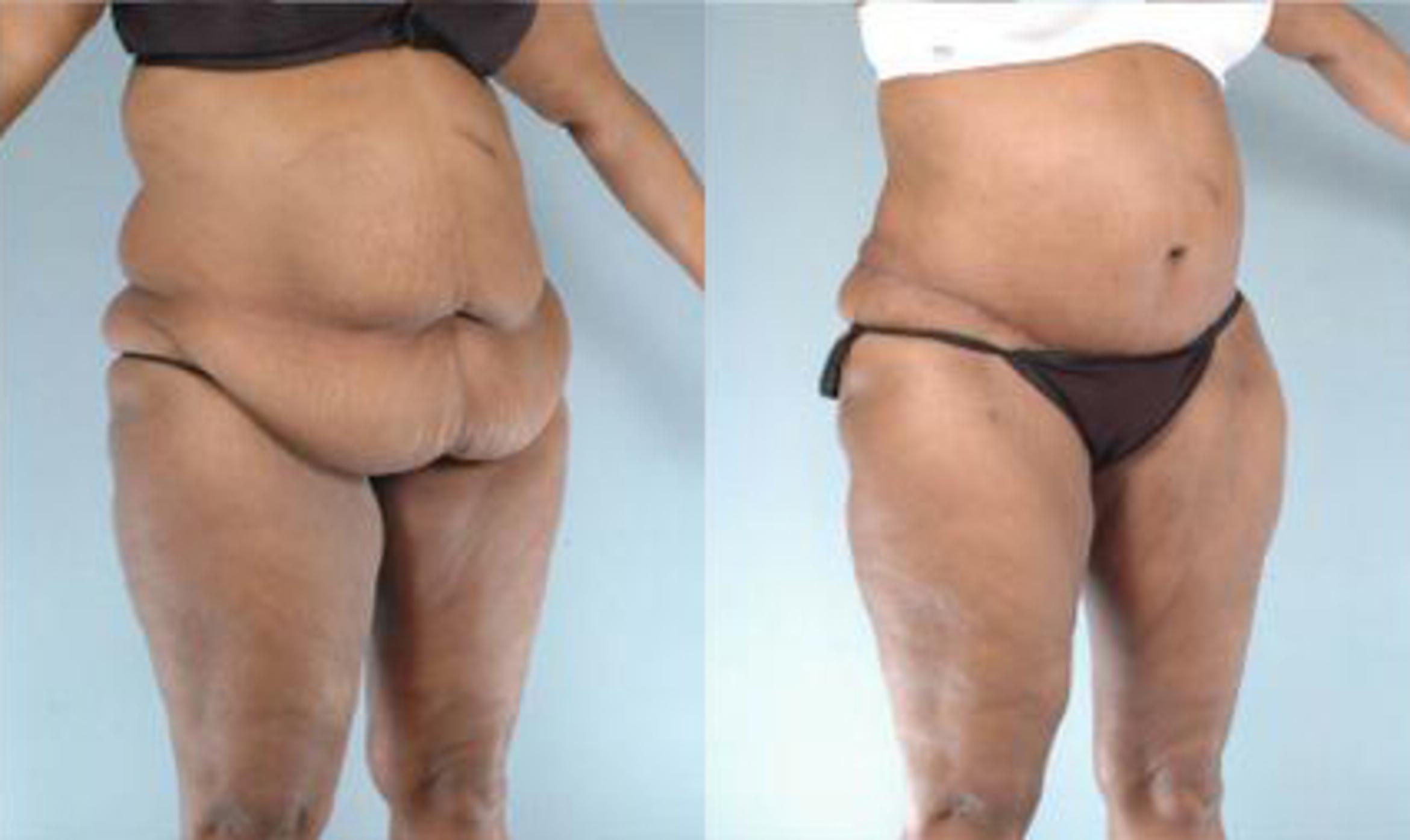 Before & After Liposuction Case 3897 View 2 View in Houston, TX