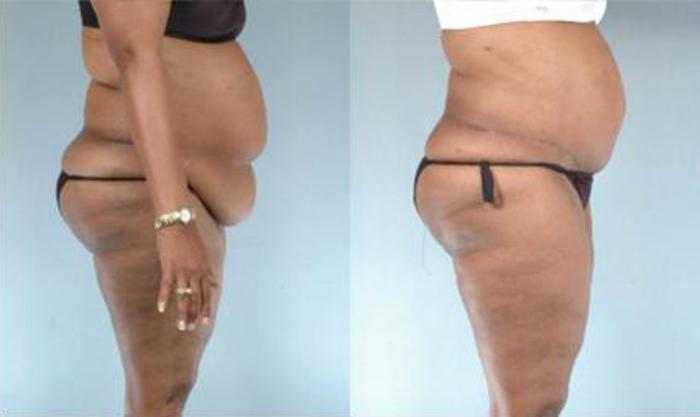 Before & After Liposuction Case 3897 View 3 View in Houston, TX
