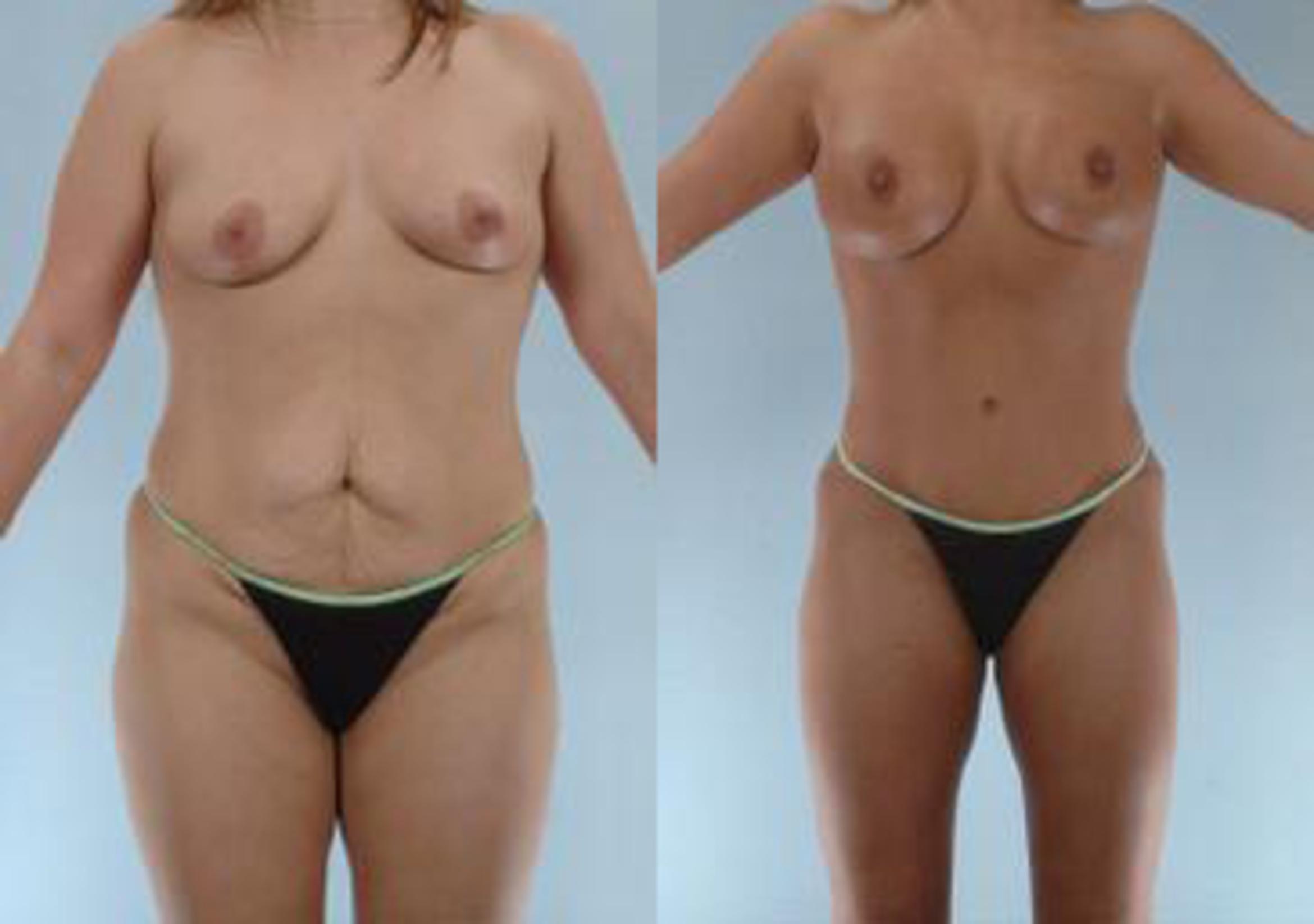 Before & After Liposuction Case 3905 View 1 View in Houston, TX