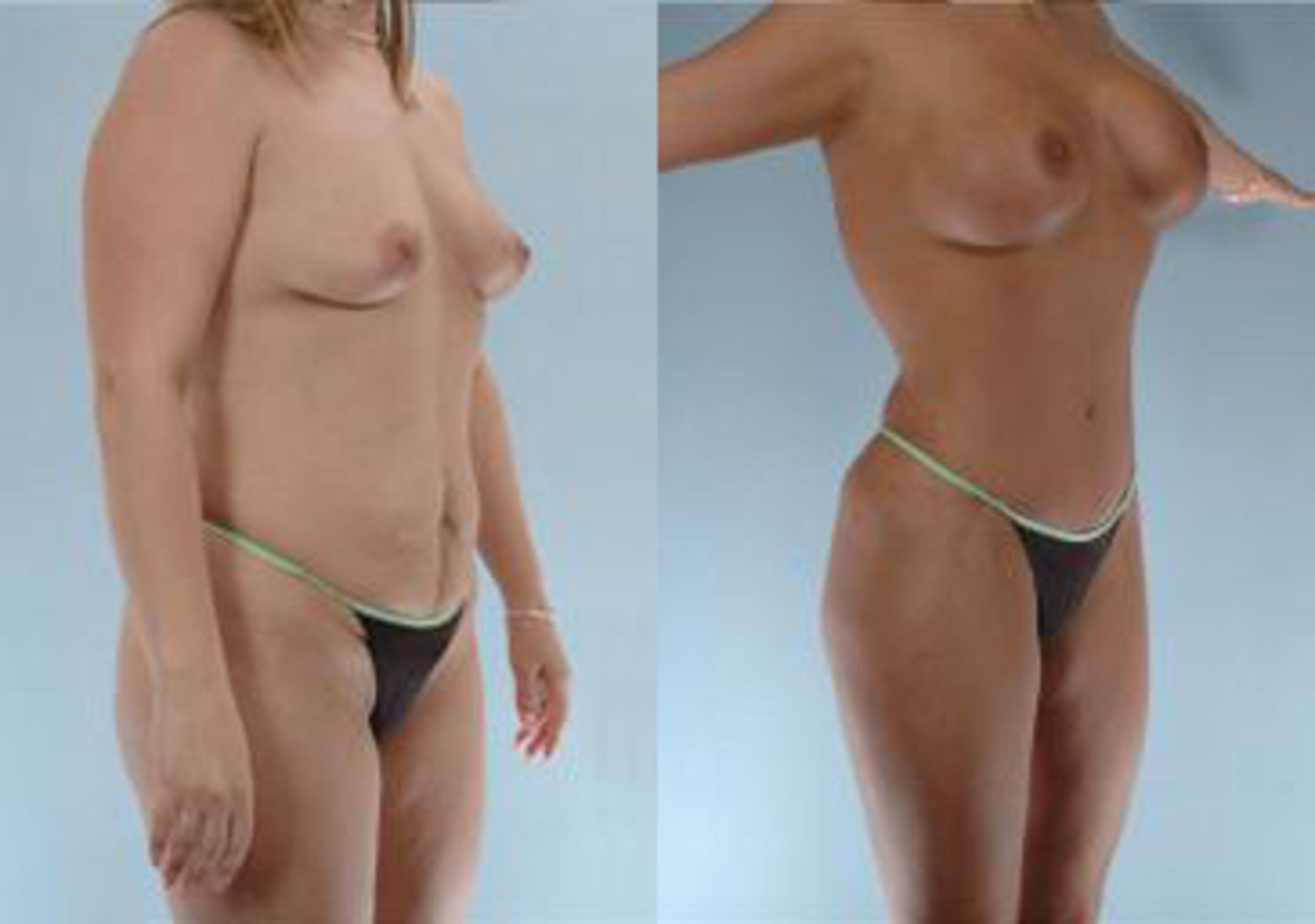 Before & After Liposuction Case 3905 View 2 View in Houston, TX