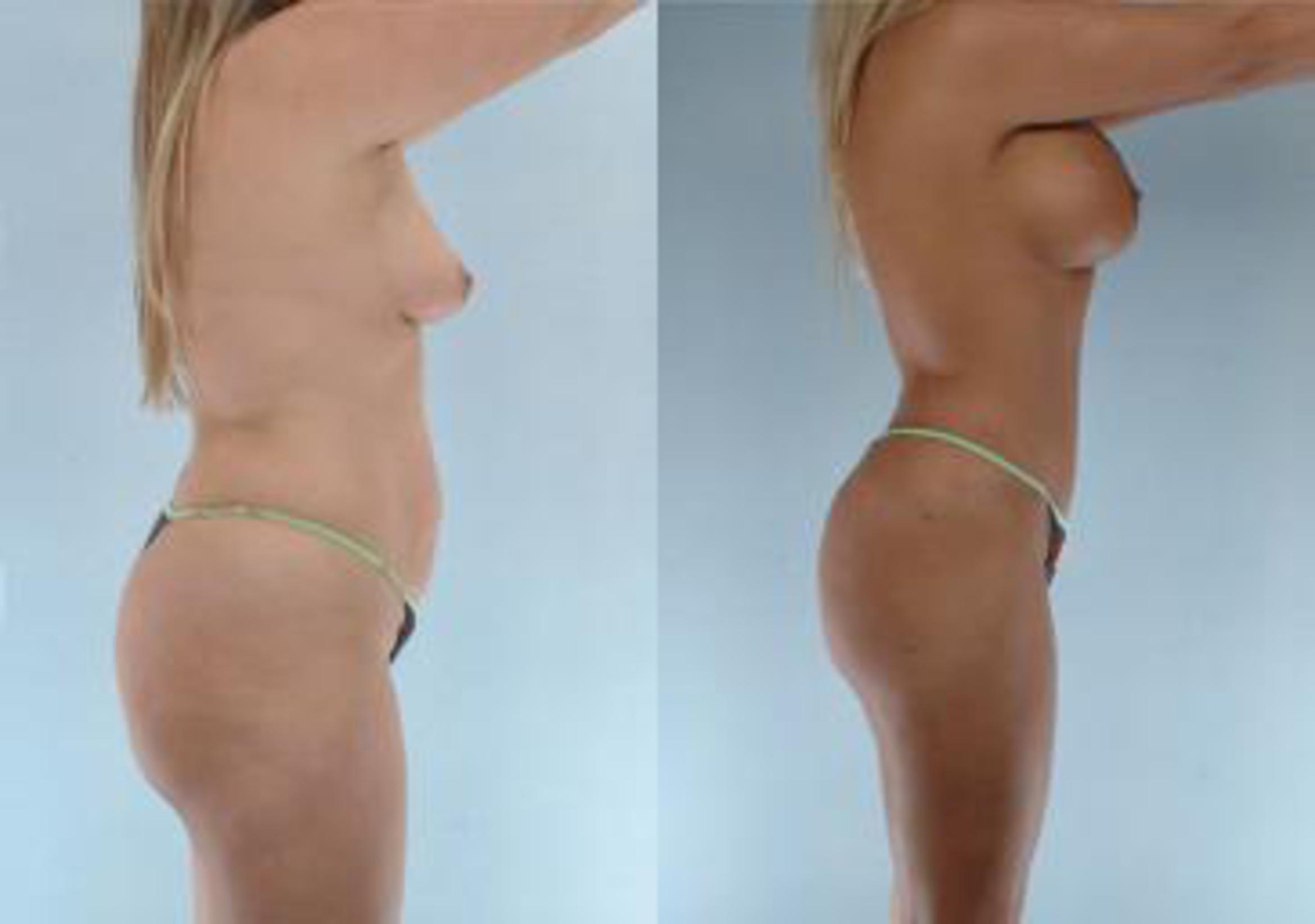 Before & After Liposuction Case 3905 View 3 View in Houston, TX