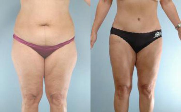 Before & After Liposuction Case 3913 View 1 View in Houston, TX