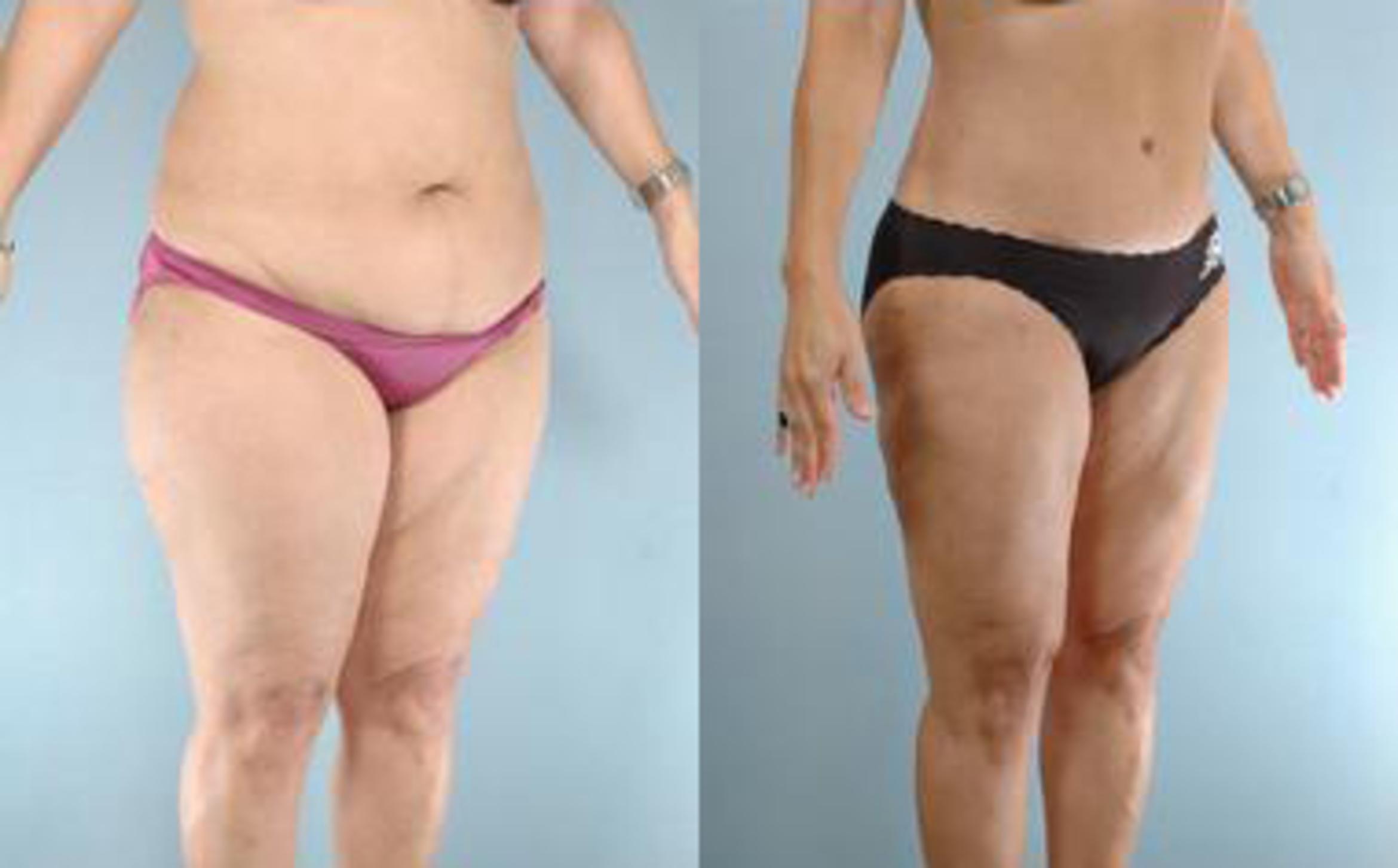 Before & After Liposuction Case 3913 View 2 View in Houston, TX