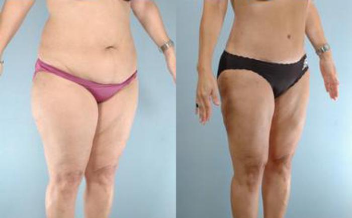 Before & After Liposuction Case 3913 View 2 View in Houston, TX