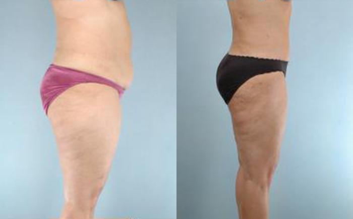 Before & After Liposuction Case 3913 View 3 View in Houston, TX