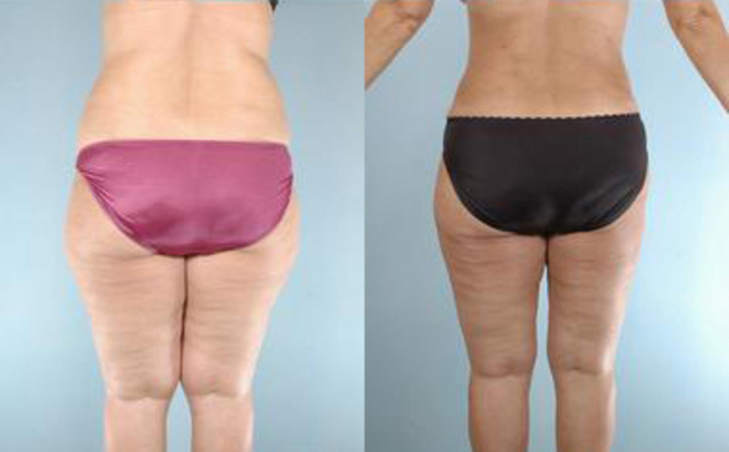Before & After Liposuction Case 3913 View 4 View in Houston, TX