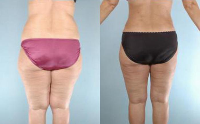 Before & After Liposuction Case 3913 View 4 View in Houston, TX