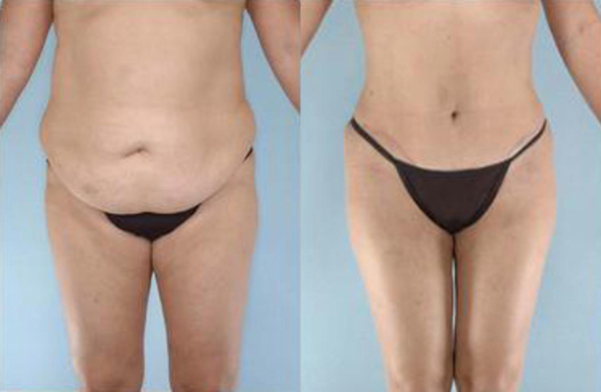 Before & After Liposuction Case 3923 View 1 View in Houston, TX