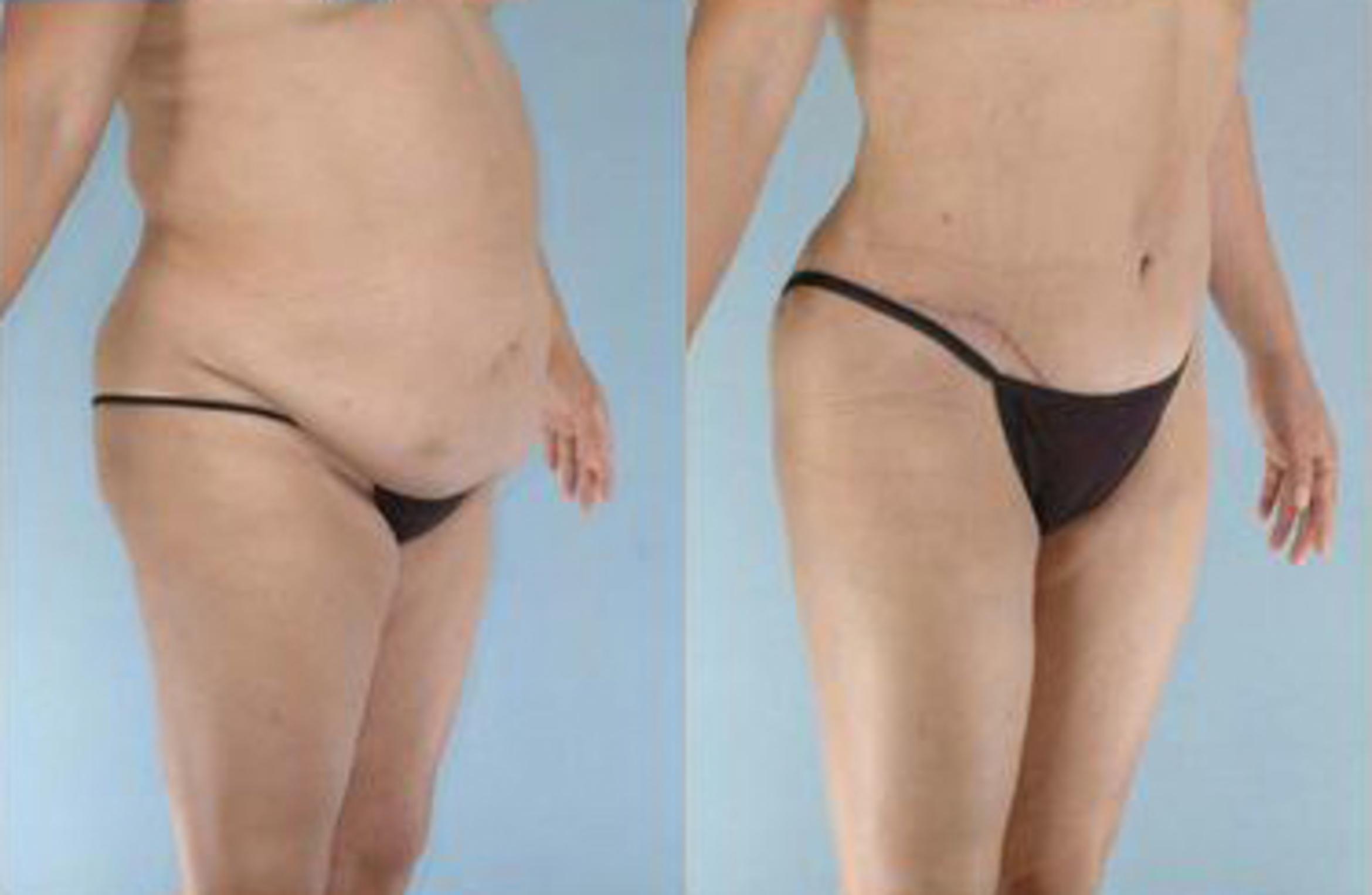 Before & After Liposuction Case 3923 View 2 View in Houston, TX