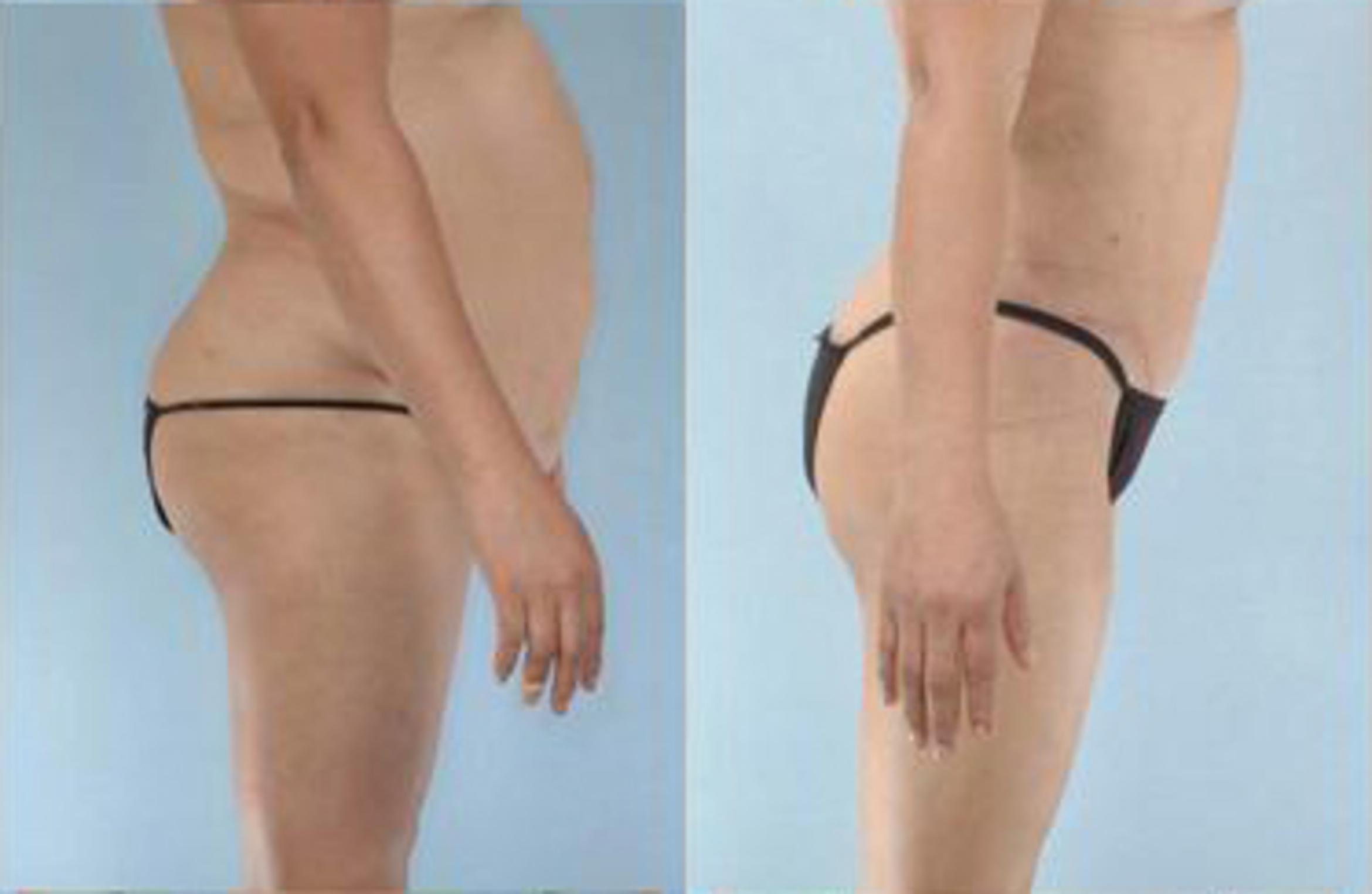 Before & After Liposuction Case 3923 View 3 View in Houston, TX