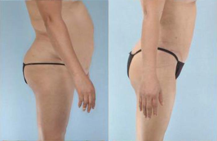 Before & After Liposuction Case 3923 View 3 View in Houston, TX