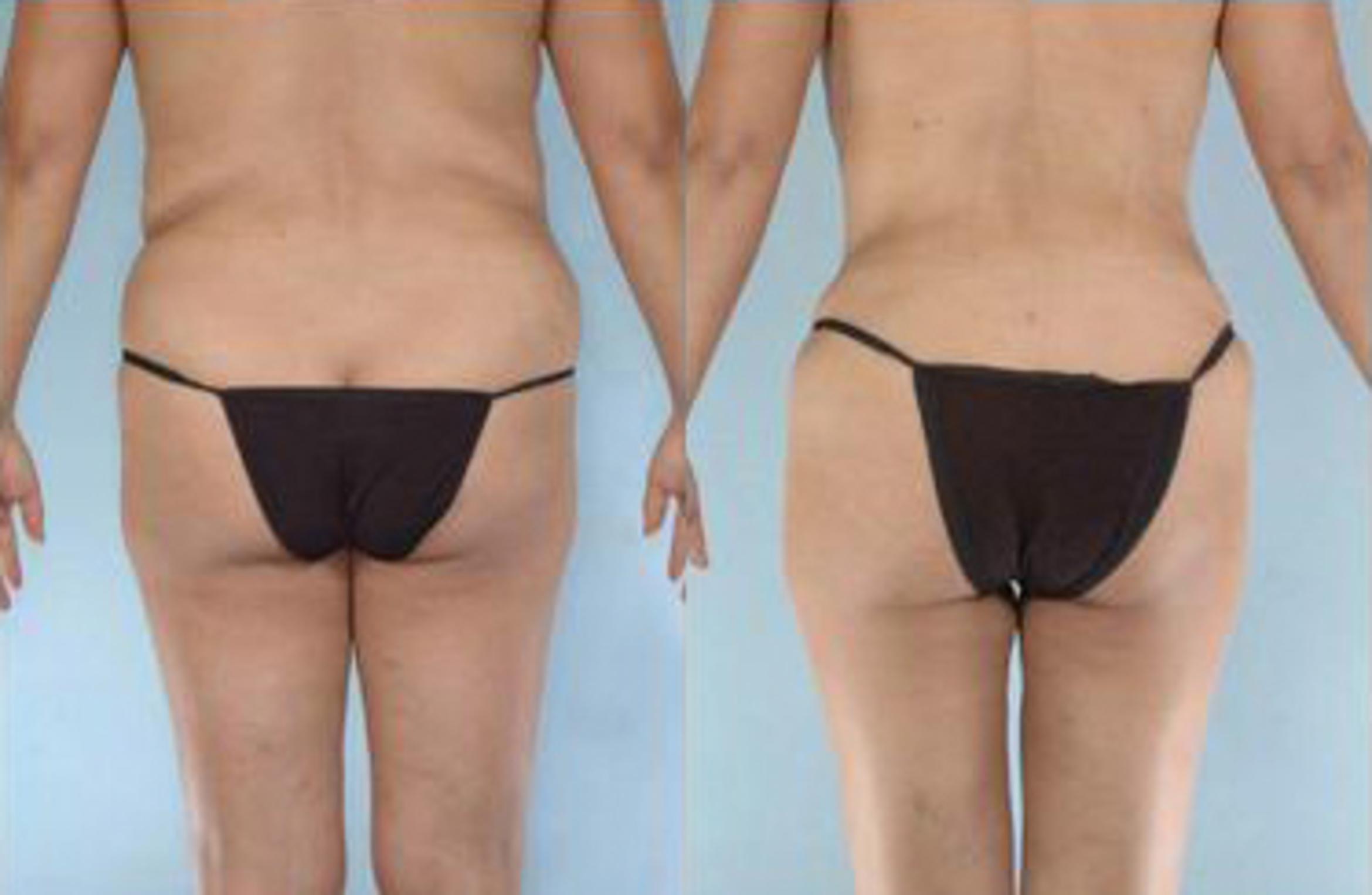 Before & After Liposuction Case 3923 View 4 View in Houston, TX