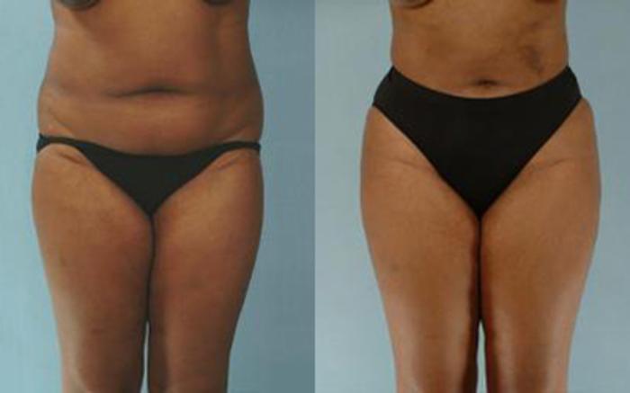 Before & After Liposuction Case 3933 View 1 View in Houston, TX