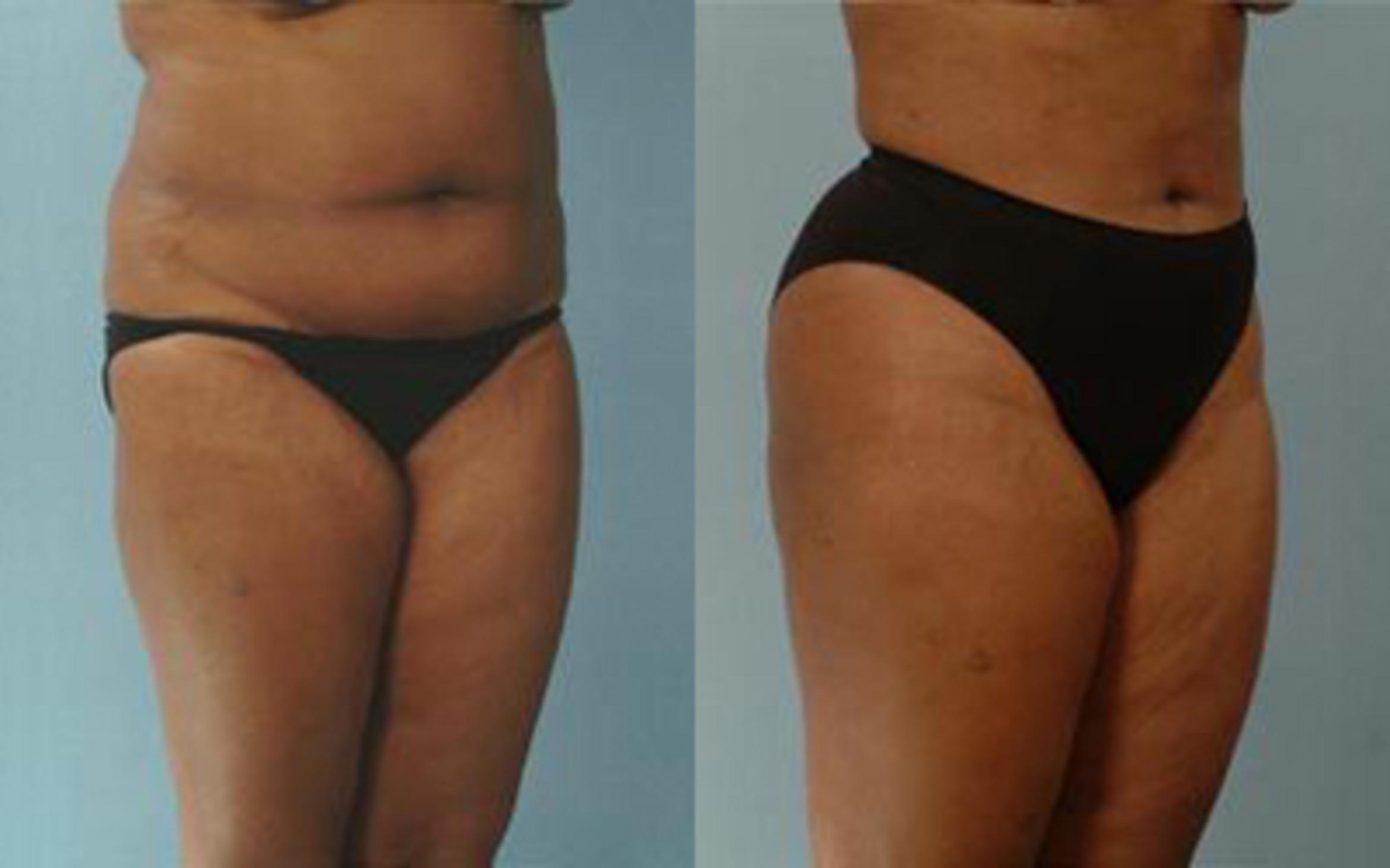 Before & After Liposuction Case 3933 View 2 View in Houston, TX