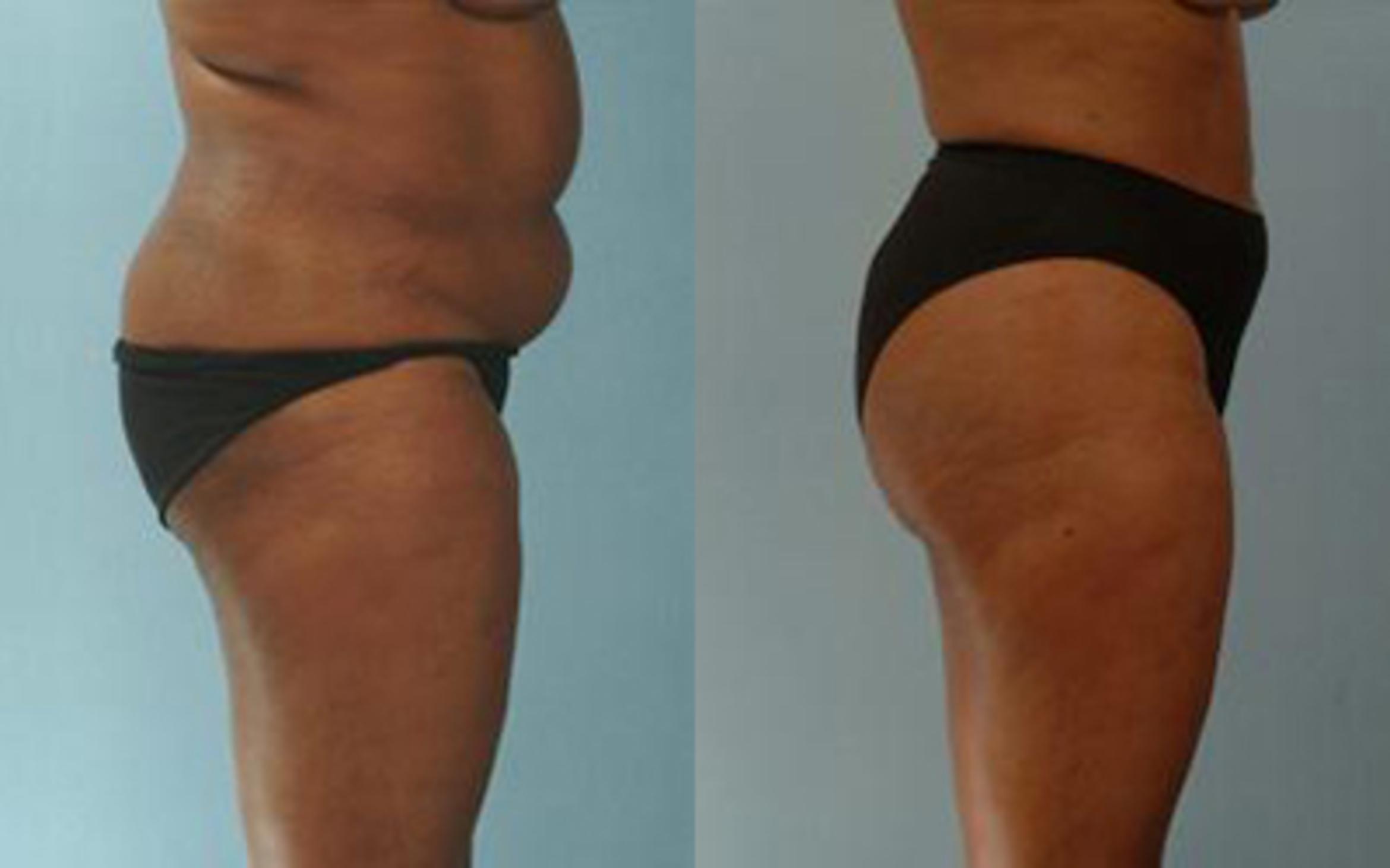 Before & After Liposuction Case 3933 View 3 View in Houston, TX