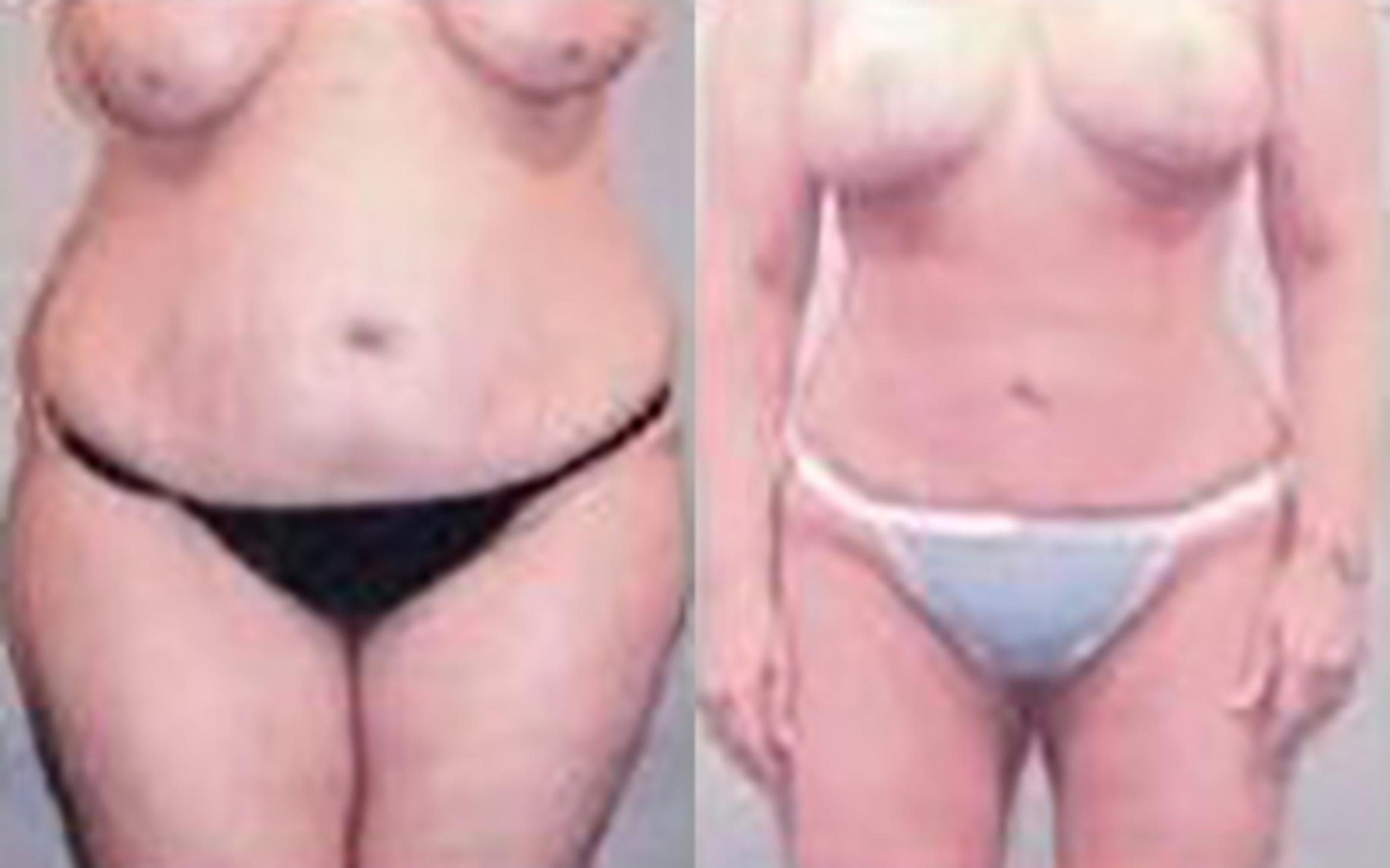 Before & After Liposuction Case 3941 View 1 View in Houston, TX