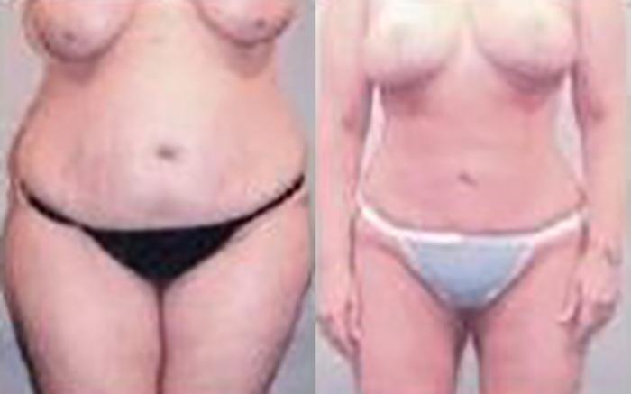 Before & After Liposuction Case 3941 View 1 View in Houston, TX
