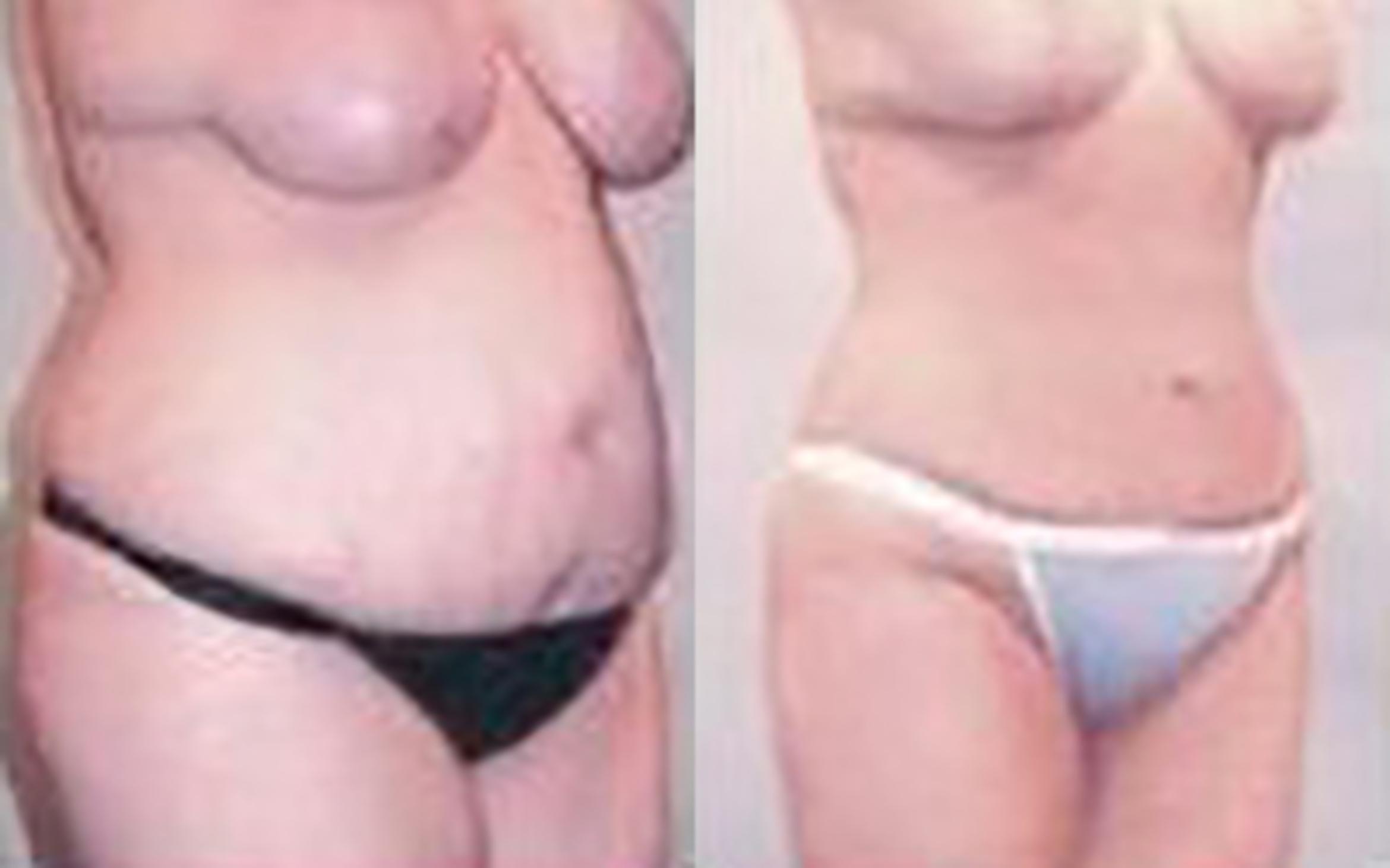 Before & After Liposuction Case 3941 View 2 View in Houston, TX